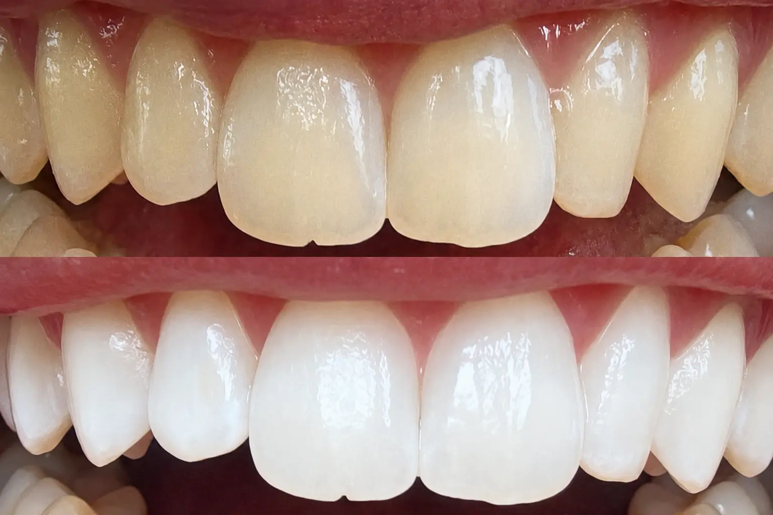 Professional teeth whitening result showing a bright, radiant white smile