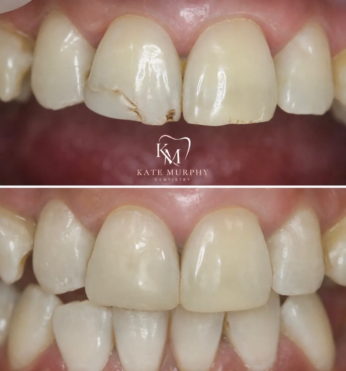 Composite bonding smile transformation result showing naturally aligned, beautifully shaped teeth