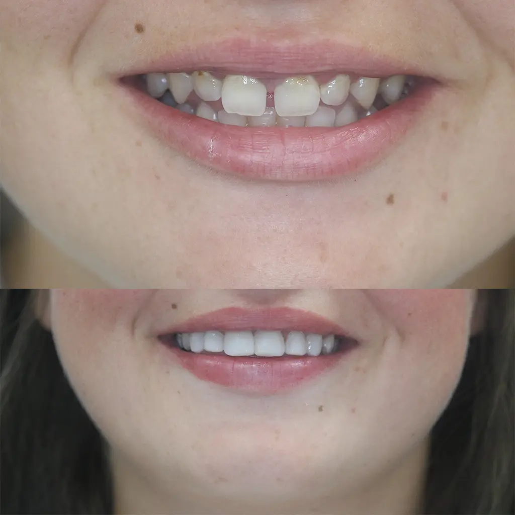 Complete smile makeover result with composite bonding and whitening